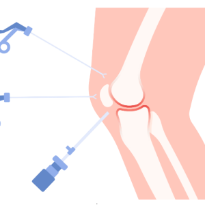 Arthroscopic Surgery