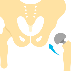 Joint replacement surgery